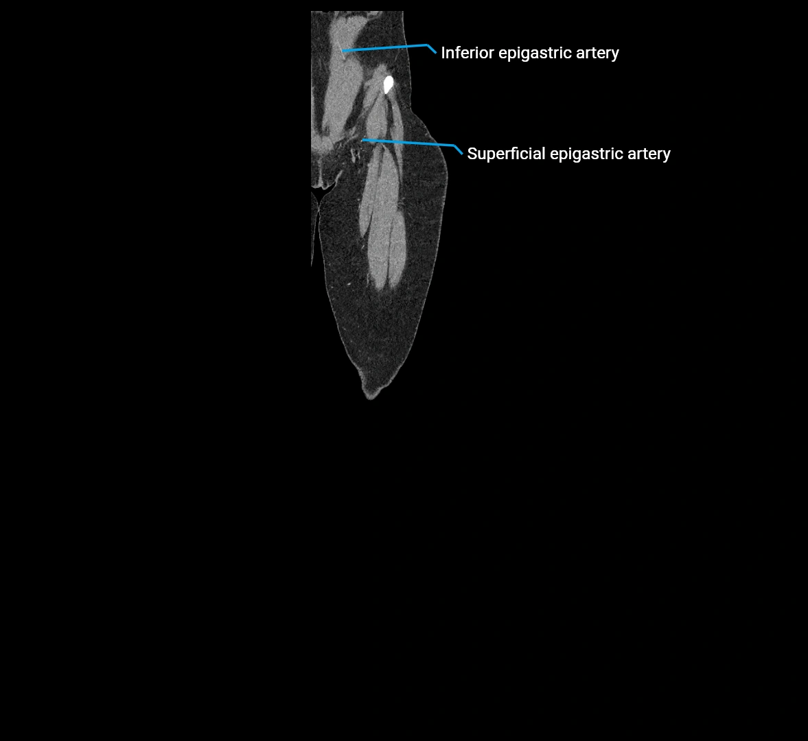 CTA lower limb coronal cross sectional anatomy labelled image _8 (1).webp